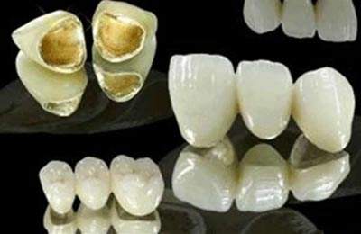 大牙做貴金屬多少錢(qián)