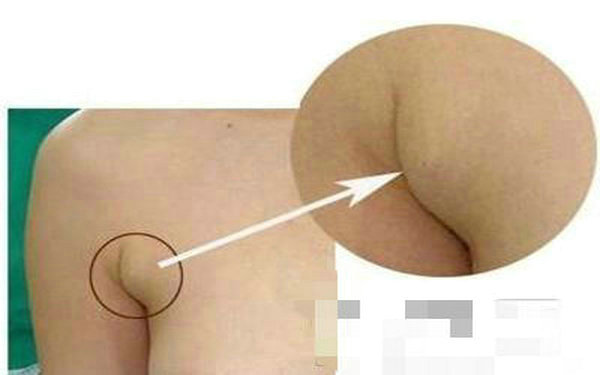 詳解副乳切除有必要嗎