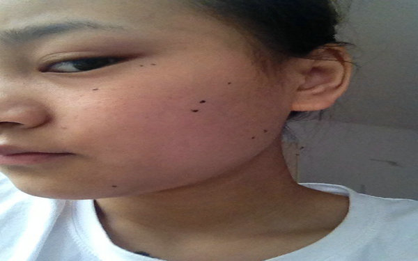 手術(shù)去痣會留疤痕嗎?