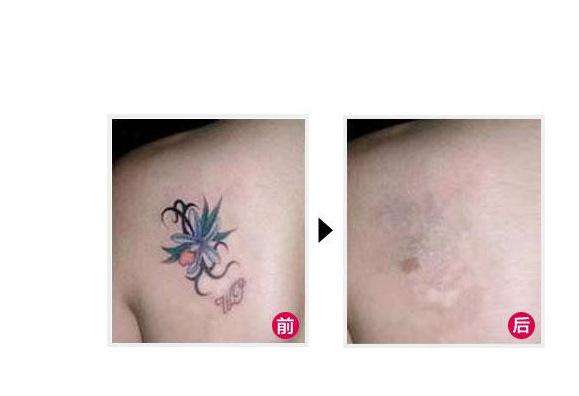 彩色紋身能洗掉嗎