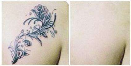 彩色紋身一次可以徹底洗掉嗎