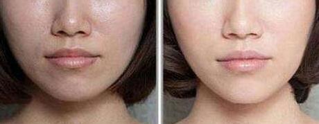 深圳硅膠<a href=http://m.f3bb6.cn/listinfo-737-0.html target=_blank class=infotextkey>隆鼻</a>要多少錢