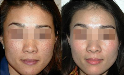 激光<a href=http://m.f3bb6.cn/listinfo-786-0.html target=_blank class=infotextkey>去黃褐斑</a>有效嗎