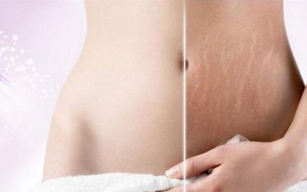 如何修復(fù)妊娠紋