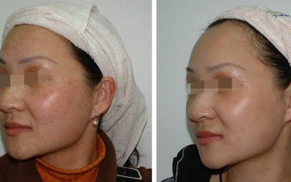 黃褐斑激光可以去掉嗎