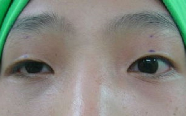 上瞼下垂手術能管幾年