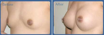 注射<a href=http://m.f3bb6.cn/listinfo-618-0.html target=_blank class=infotextkey>隆胸</a>并發癥