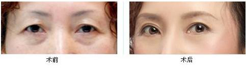 韓式<a href=http://m.f3bb6.cn/listinfo-655-0.html target=_blank class=infotextkey>切眉</a>術(shù)做法有哪些