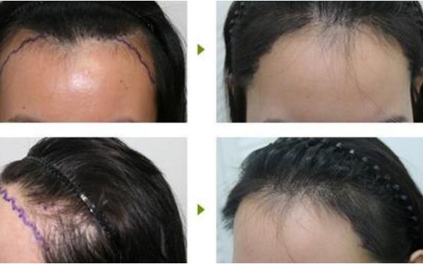 重慶哪個脫發醫院較好