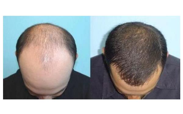 重慶<a href=http://m.f3bb6.cn/listinfo-662-0.html target=_blank class=infotextkey>治療脫發</a>醫院哪個較好