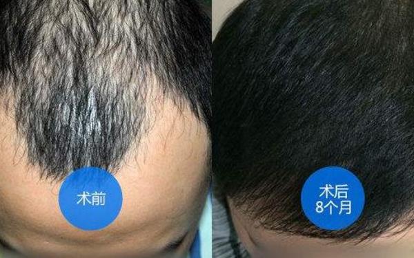 太原哪里治脫發