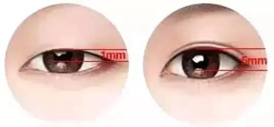 縫合疤痕怎么去除