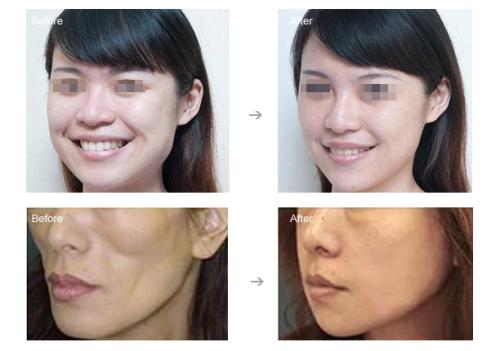 自體脂肪面部填充多少錢