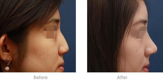 注射<a href=http://m.f3bb6.cn/listinfo-737-0.html target=_blank class=infotextkey>隆鼻</a>為什么受到人們的歡迎