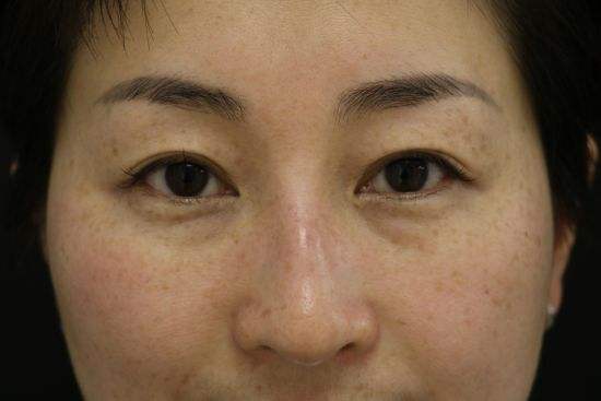 安效果很全果很好去除黃褐斑的方式是什么