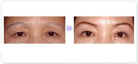 <a href=http://m.f3bb6.cn/listinfo-734-0.html target=_blank class=infotextkey>愛貝芙</a><a href=http://m.f3bb6.cn/listinfo-654-0.html target=_blank class=infotextkey>隆眉弓</a>后吃東西受影響嗎