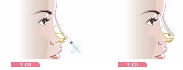 硅膠<a href=http://m.f3bb6.cn/listinfo-737-0.html target=_blank class=infotextkey>隆鼻</a>的副作用