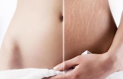 激光去除妊娠紋的價格