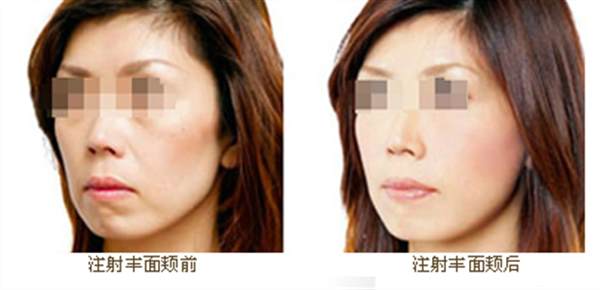 臉部脂肪填充多少錢