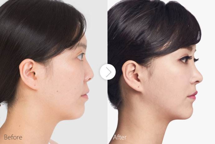 有關自體軟骨<a href=http://m.f3bb6.cn/listinfo-737-0.html target=_blank class=infotextkey>隆鼻</a>的術后恢復