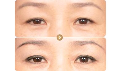 <a href=http://m.f3bb6.cn/listinfo-655-0.html target=_blank class=infotextkey>切眉</a>后飲食禁忌需要注意什么