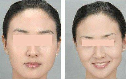 <a href=http://m.f3bb6.cn/listinfo-655-0.html target=_blank class=infotextkey>切眉</a>失敗后遺癥怎么處理