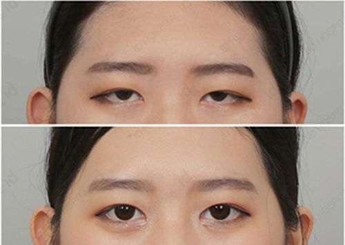 做完<a href=http://m.f3bb6.cn/listinfo-655-0.html target=_blank class=infotextkey>切眉</a>后注意事項