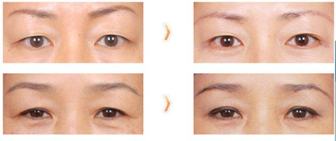 <a href=http://m.f3bb6.cn/listinfo-655-0.html target=_blank class=infotextkey>切眉</a>手術(shù)失敗修復(fù)怎么做