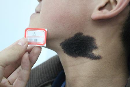 割胎記要多少錢