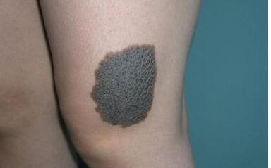 割黑色胎記要多少錢