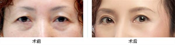 春季提眉術(shù)會(huì)有疤痕嗎