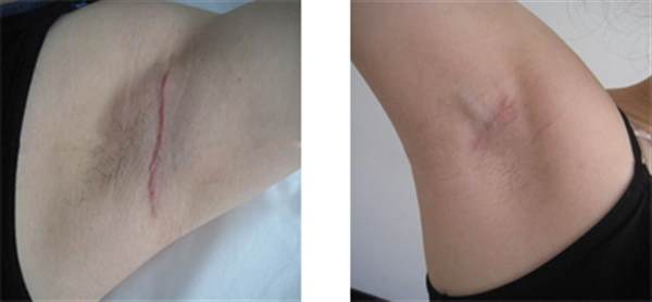 狐臭可以激光治療嗎