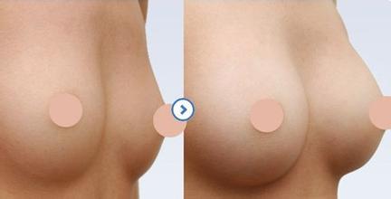 注射<a href=http://m.f3bb6.cn/listinfo-618-0.html target=_blank class=infotextkey>隆胸</a>失敗修復(fù)手術(shù)