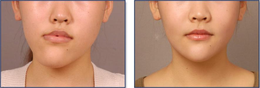 上海怎樣快速消除頸紋