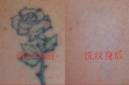 電灼去紋身優點