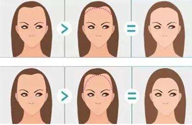 種植過發跡線效果怎樣