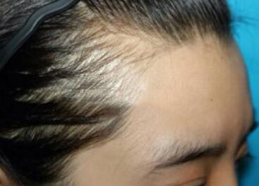 紋繡發際線禁忌人群