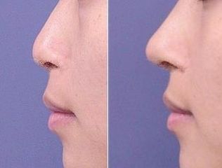 南京韓式<a href=http://m.f3bb6.cn/listinfo-737-0.html target=_blank class=infotextkey>隆鼻</a>哪里好