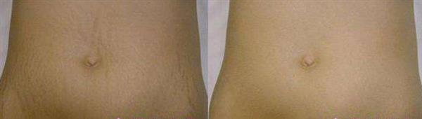 深州<a href=http://m.f3bb6.cn/listinfo-613-0.html target=_blank class=infotextkey>射頻</a>治療腹部妊娠紋好嗎