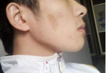 2厘米的植皮手術多少錢