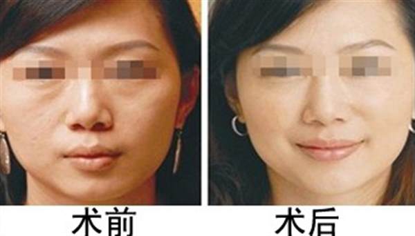 常州自體脂肪豐面頰