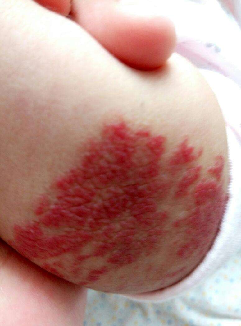 去紅色胎記多少錢?