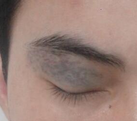 <a href=http://m.f3bb6.cn/listinfo-799-0.html target=_blank class=infotextkey>去太田痣</a>多少錢?