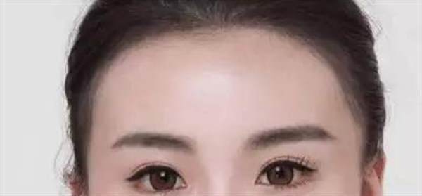 發際線后移能不能恢復