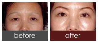 提眉術后的注意事項及效果？