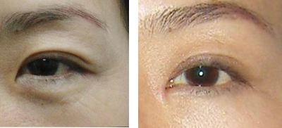 韓式提眉術做法有幾種?