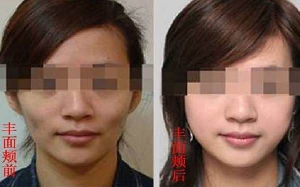 大連做面部填充要多少錢