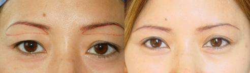 韓式<a href=http://m.f3bb6.cn/listinfo-655-0.html target=_blank class=infotextkey>切眉</a>術(shù)效果及注意事項？