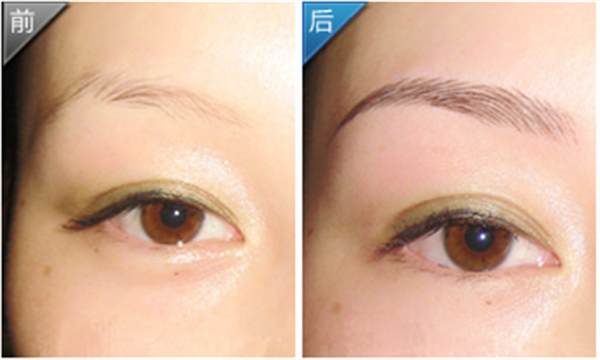 <a href=http://m.f3bb6.cn/listinfo-655-0.html target=_blank class=infotextkey>切眉</a>術(shù)的原理?