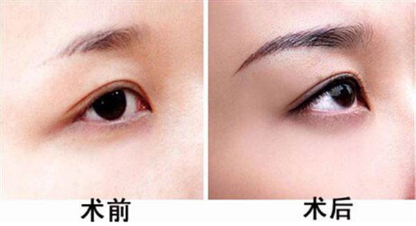 <a href=http://m.f3bb6.cn/listinfo-655-0.html target=_blank class=infotextkey>切眉</a>術與提眉術對比?